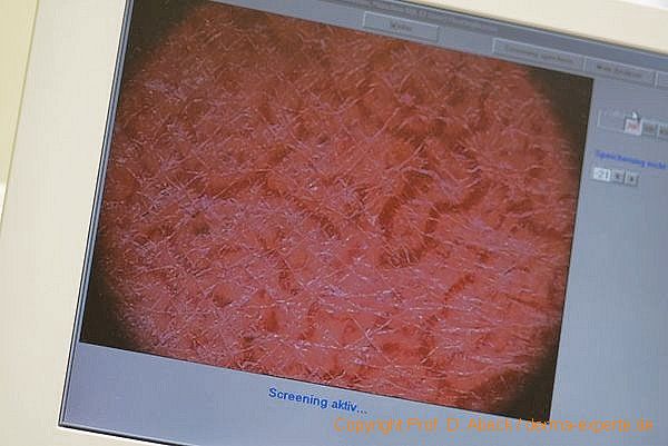 Rosazea. Darstellung der Gefäßvermehrung mittels Dermatoskopie. Rosazea. Darstellung der Gefäßvermehrung mittels Dermatoskopie.